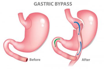 Gastric Bypass